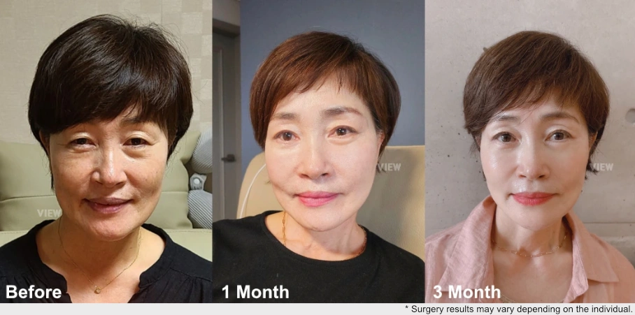 Recovery progress comparison showing facial rejuvenation before surgery and at one month and three months after anti-aging surgery, illustrating gradual improvement and more balanced facial appearance.