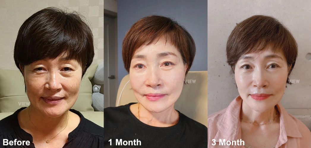 Progress comparison showing facial rejuvenation before surgery and at one month and three months after anti-aging surgery, illustrating gradual recovery and more balanced facial appearance.
