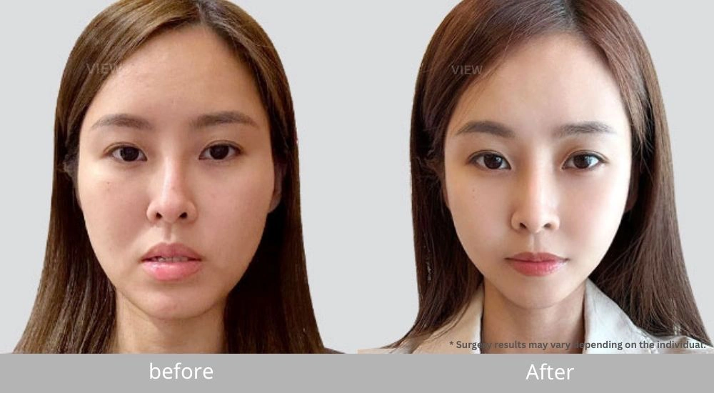 before after facial contour comparison front view 1