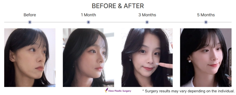 Side profile before-and-after timeline showing facial appearance changes before surgery and at 1 month, 3 months, and 5 months post-surgery.