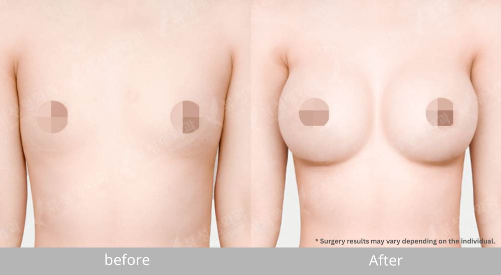 Breast Implants before and after results showing increased volume and natural breast shape
