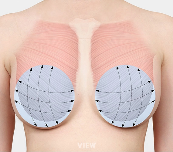 Illustration showing breast implant positioning beneath the chest muscle and the directional forces affecting implant shape