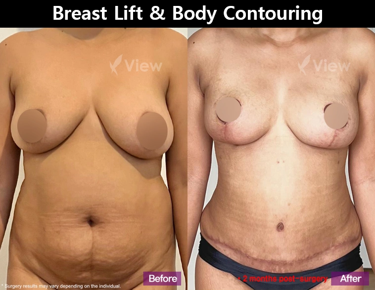Before and after results of breast lift and body contouring surgery showing improved breast position and a smoother abdominal contour at 2 months post-surgery