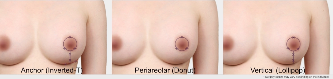 Medical illustration comparing breast lift incision types, including anchor (inverted-T), periareolar (donut), and vertical (lollipop) techniques used in mastopexy.