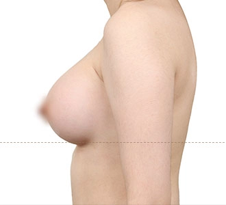 Self-assessment guide illustrating breast ptosis levels based on nipple position relative to the breast crease to help determine whether a breast lift may be needed