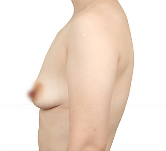 Self-assessment guide illustrating breast ptosis levels based on nipple position relative to the breast crease to help determine whether a breast lift may be needed