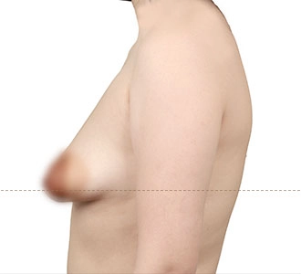 breast ptosis self assessment need for breast03