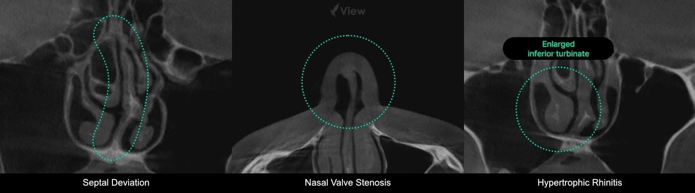 CT scan comparison showing septal deviation, nasal valve stenosis, and inferior turbinate hypertrophy