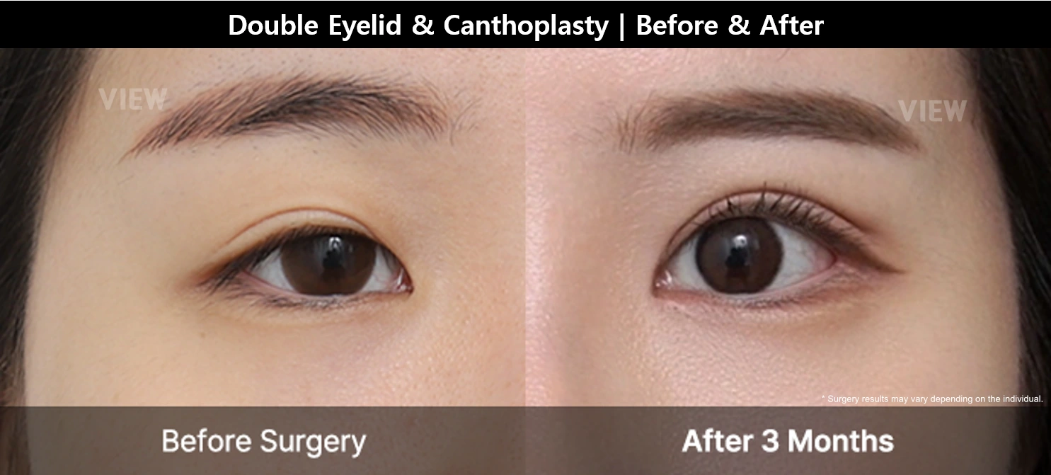 double eyelid canthoplasty before after 3 months eye surgery
