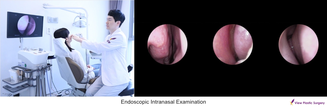 endoscopic intranasal examination functional rhinoplasty korea