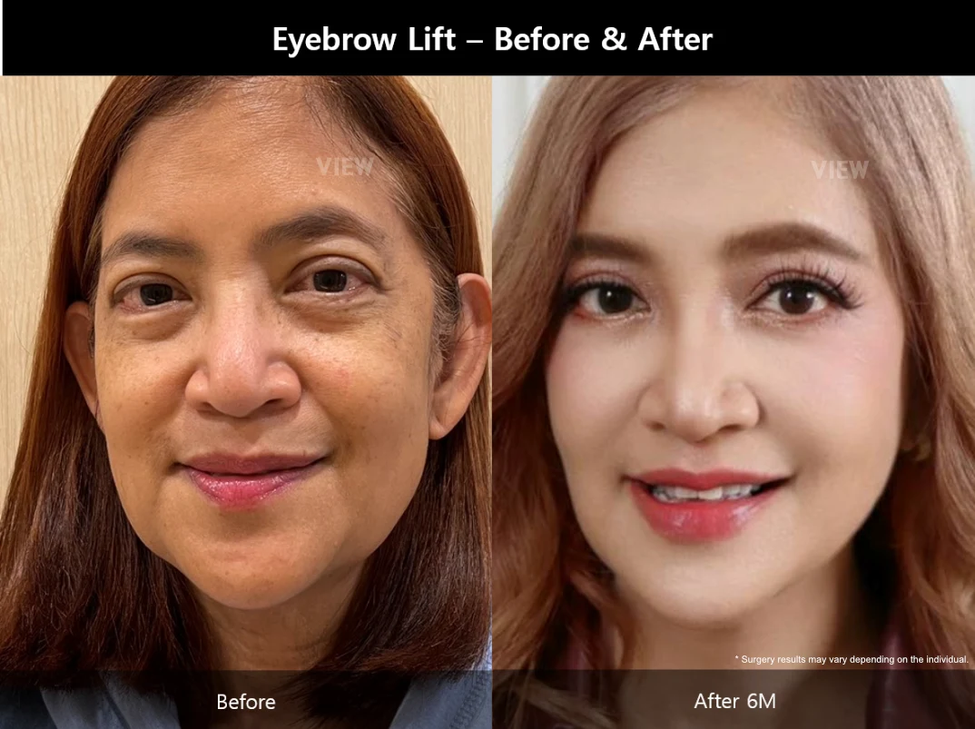 Before and after comparison of eyebrow lift surgery showing improved brow position and a more refreshed appearance at six months