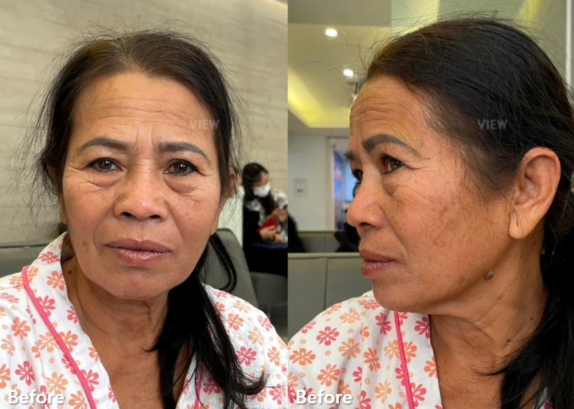 Clinical before-treatment images showing facial aging changes, including wrinkles, skin laxity, and volume loss commonly observed with natural aging.