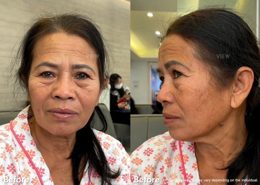 Clinical before-treatment images showing facial aging changes from front and side views, including wrinkles, skin laxity, and volume loss associated with natural aging.