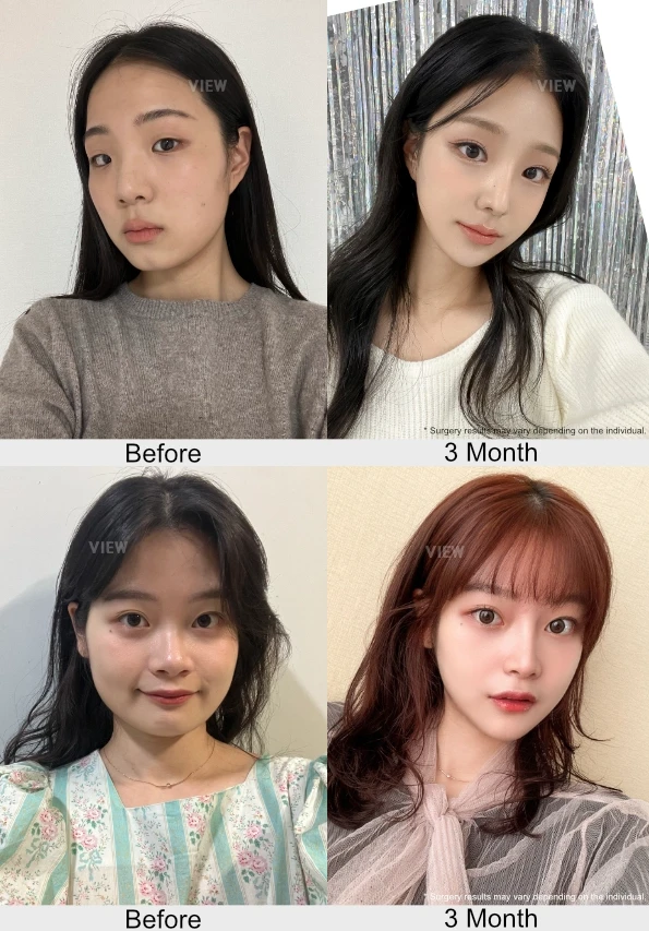 Before and after facial contouring and anti-aging treatment showing natural appearance changes at 3 months post procedure