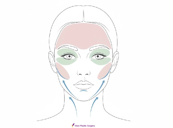 facial lifting treatment map face diagram target areas