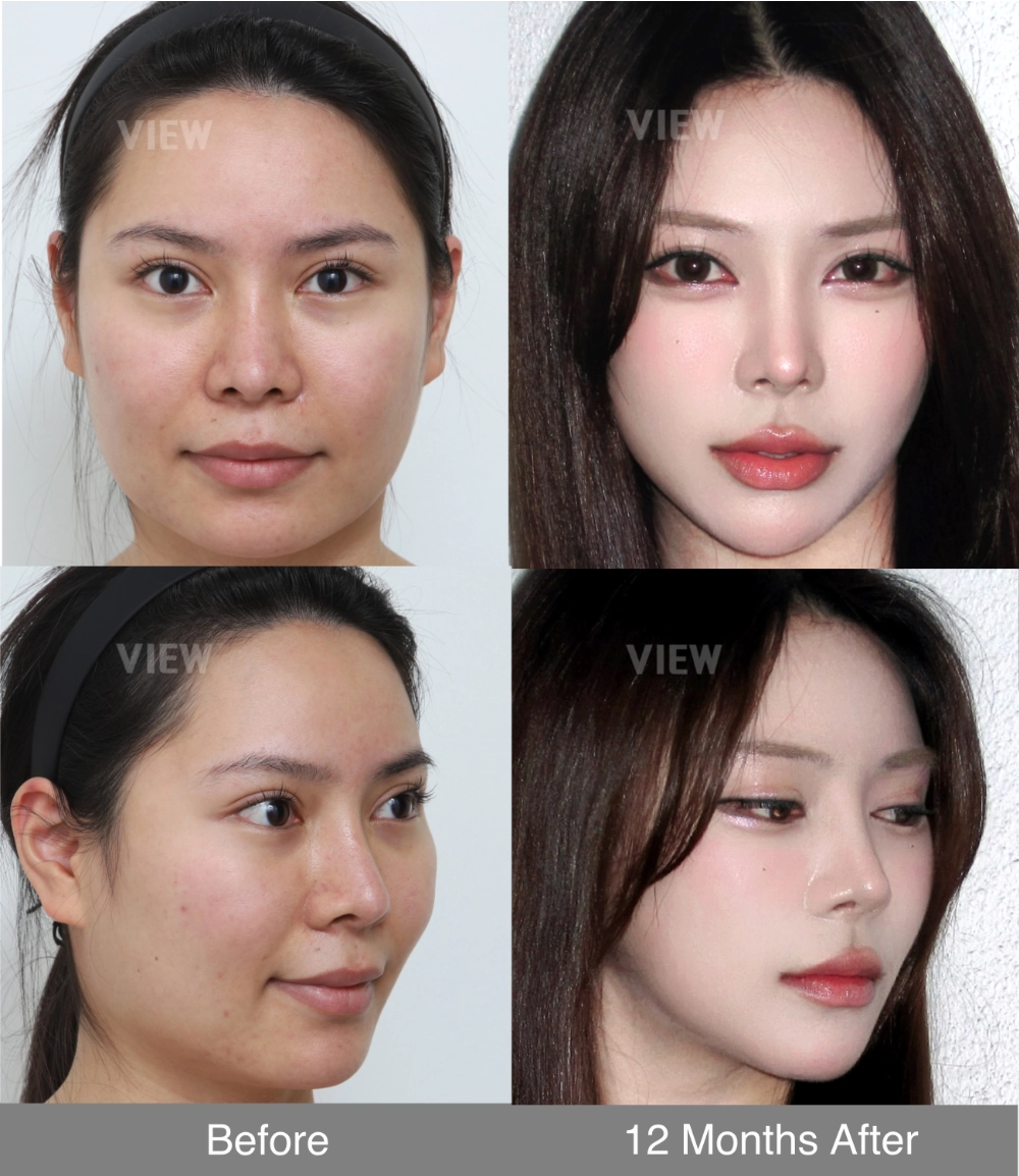 Illustrative image highlighting the key effects of facial contouring surgery, including improved facial balance, refined jawline definition, and smoother overall facial proportions