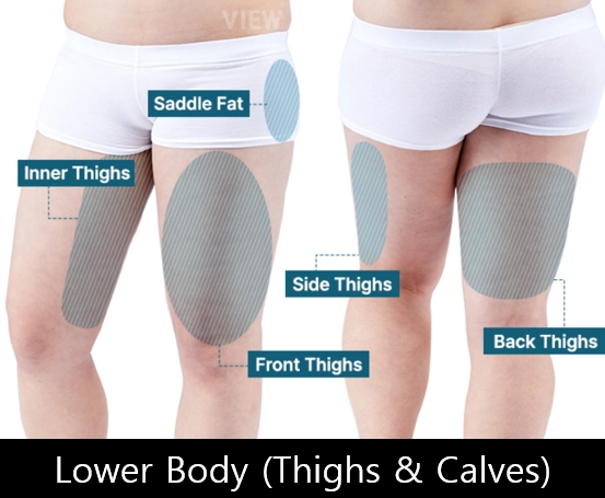 Thigh liposuction areas including inner thighs, front thighs, side thighs, back thighs, and saddle fat in Korea
