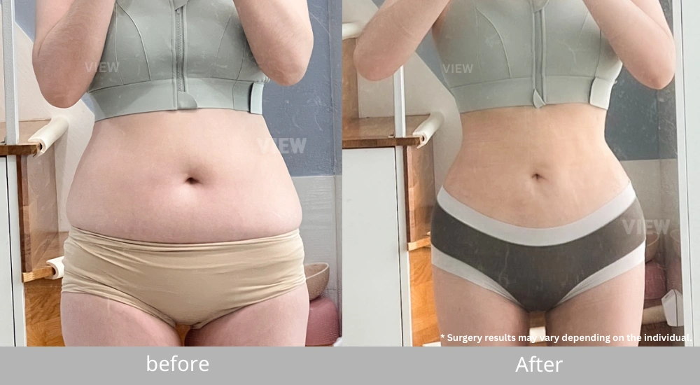 Real patient selfie showing liposuction before and after results with visible scar improvement during recovery in Korea