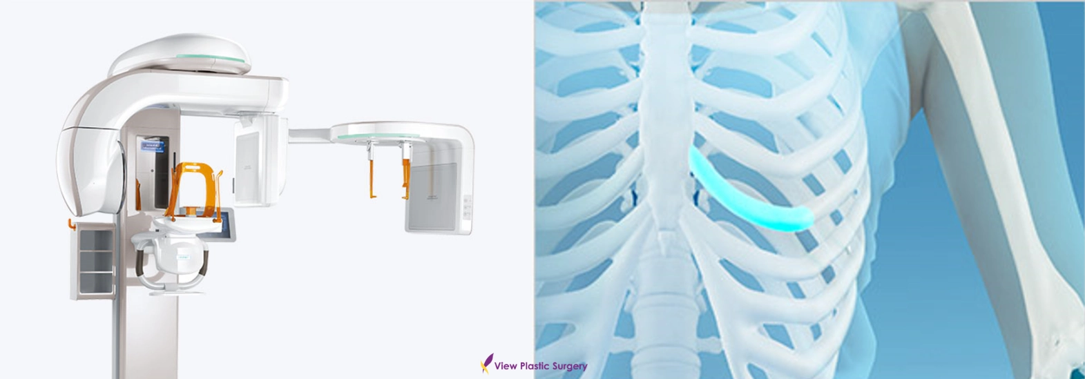 Medical imaging system used for preoperative evaluation, shown alongside a 3D visualization of rib cage anatomy for accurate surgical assessment.