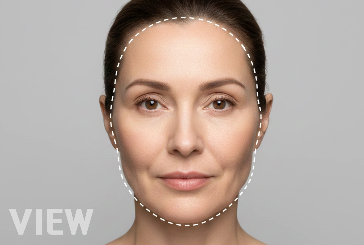 Thumbnail image illustrating midface rejuvenation using fat and stem cells, highlighting correction of a peanut-shaped face by restoring midface volume and facial balance