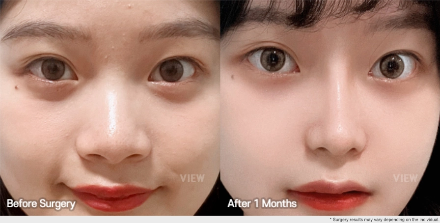 Before and after comparison of nose alar reduction surgery showing changes at 1 month post procedure, with a more refined nasal base and reduced alar width
