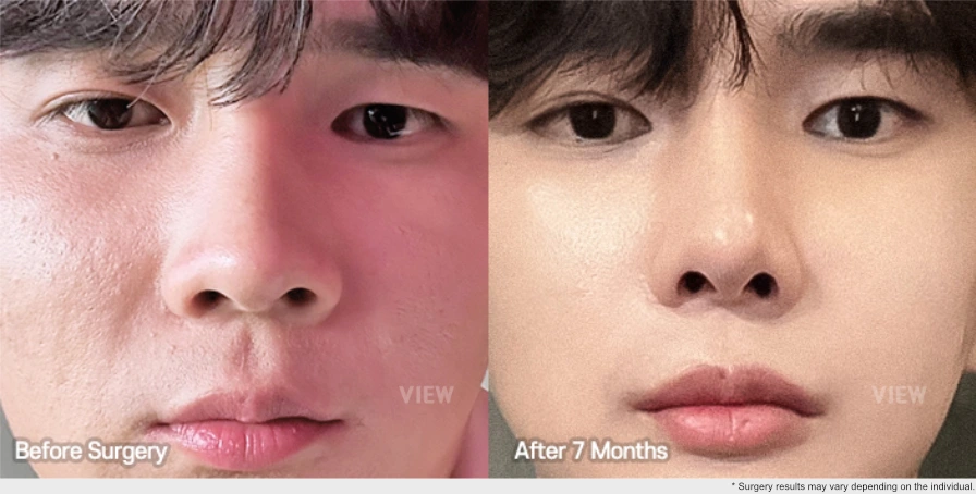 nose alar reduction surgery before after 7 months