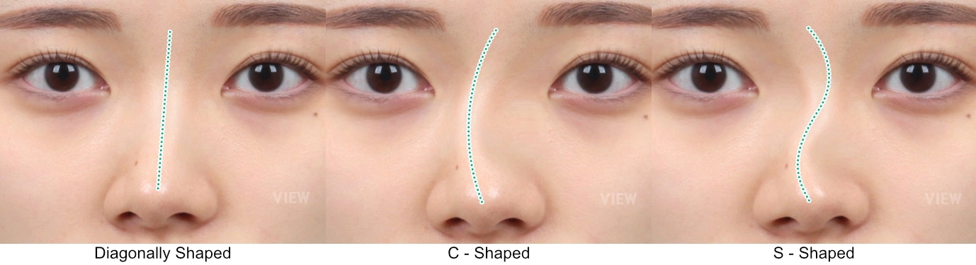 Comparison of nose bridge line types: diagonal, C-shaped, and S-shaped nose design