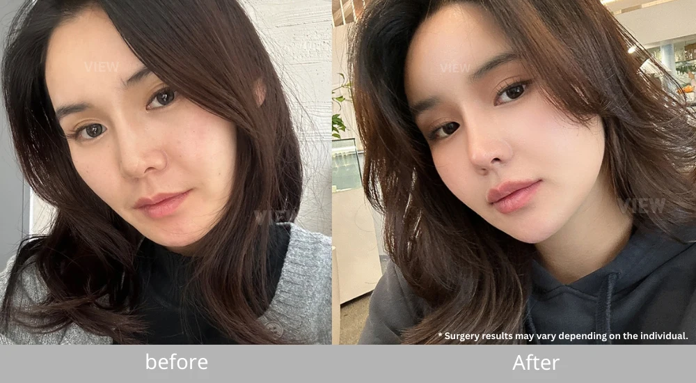 Ozempic Face correction with fat grafting before and after comparison showing facial volume restoration and improved contour after procedure