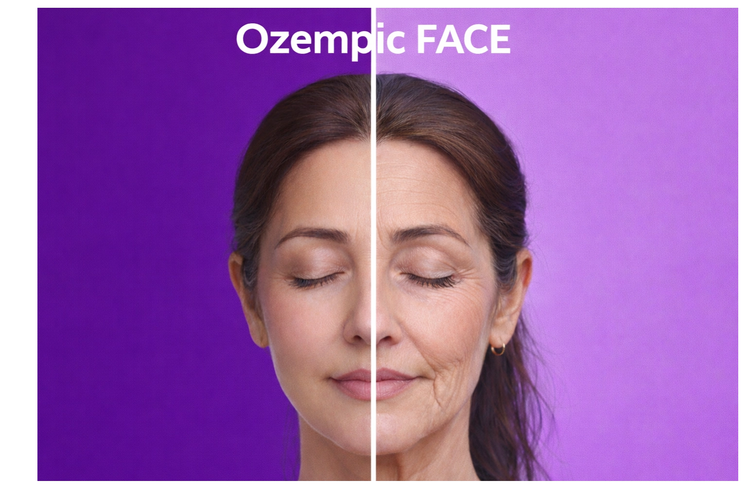 Thumbnail image illustrating facial volume loss after significant weight loss, often referred to as ‘Ozempic Face,’ and the role of fat grafting in restoring facial balance