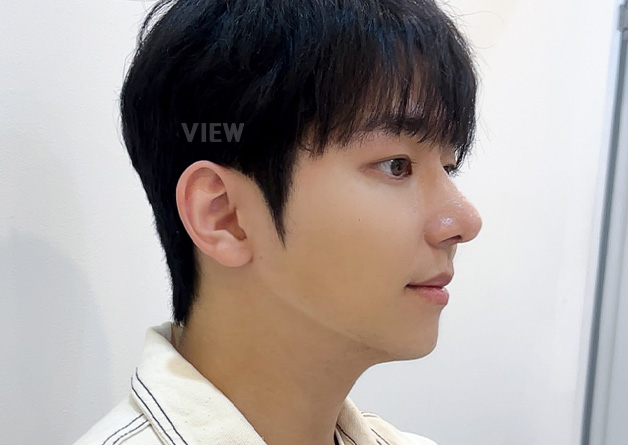 My Eye and Nose Surgery in Korea, Honest Recovery Review at VIEW Plastic Surgery