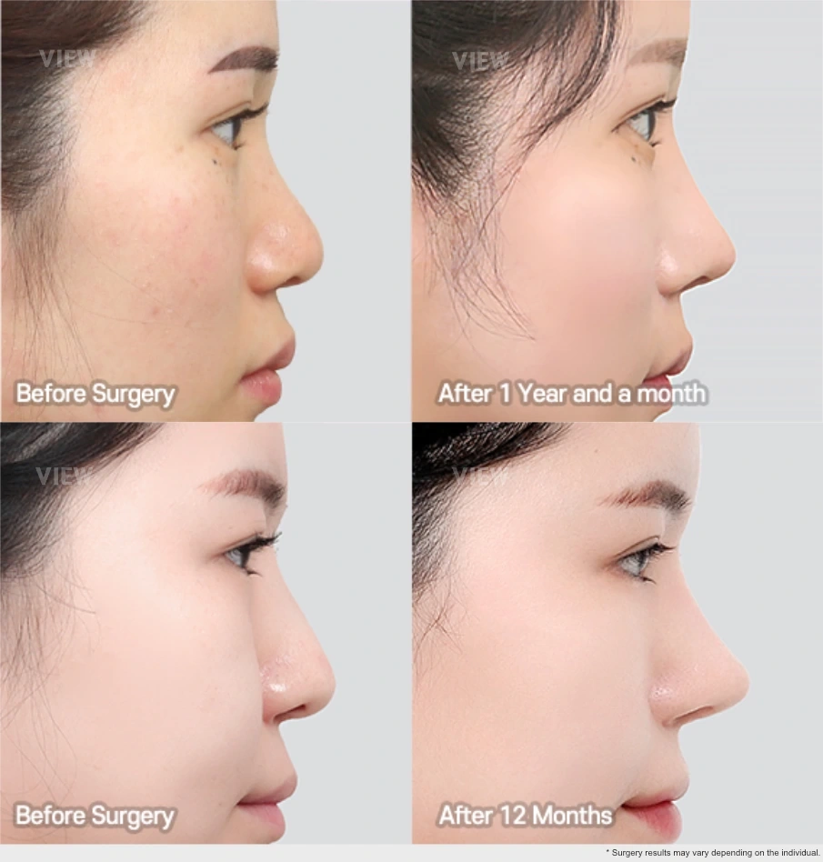 Side profile before and after comparison of rhinoplasty showing long-term nasal shape changes 12 months after surgery.