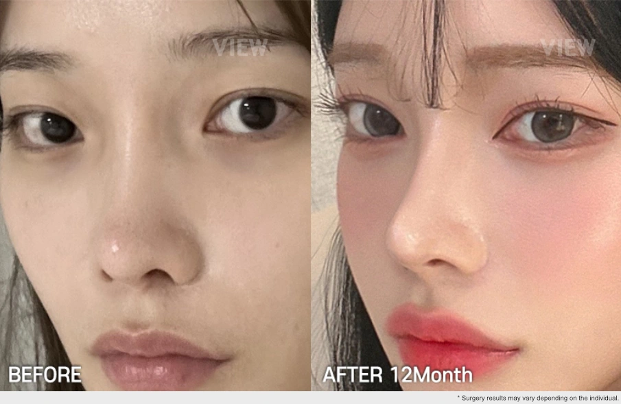 Revision rhinoplasty before and after 12 months long-term nose result in Korea