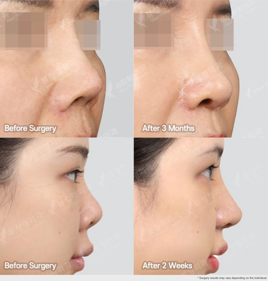 Side profile before and after comparison of rhinoplasty showing early and mid-stage nasal changes at 2 weeks and 3 months after surgery.