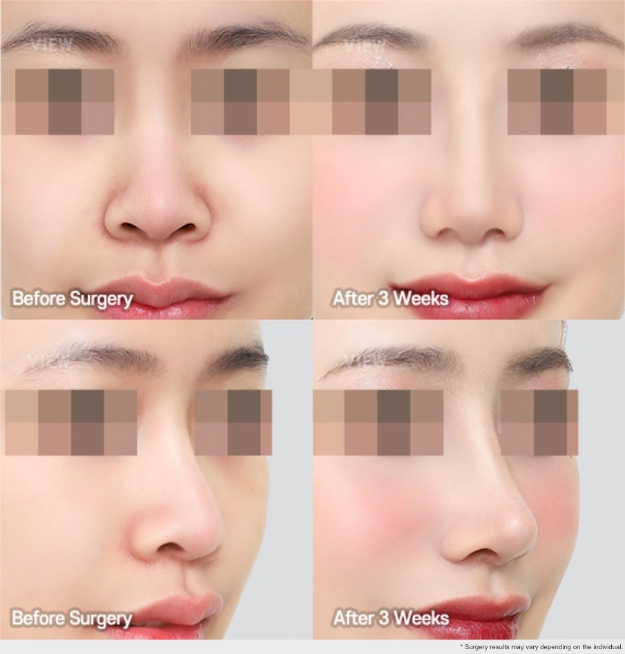 Before and after comparison of rhinoplasty results showing nasal shape changes three weeks after nose surgery.