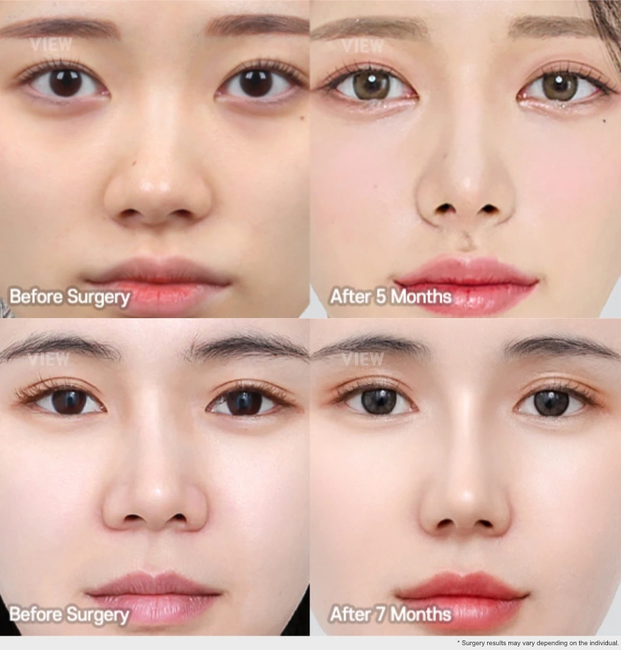 Front view before and after comparison of rhinoplasty showing progressive nasal changes at 5 and 7 months after surgery.