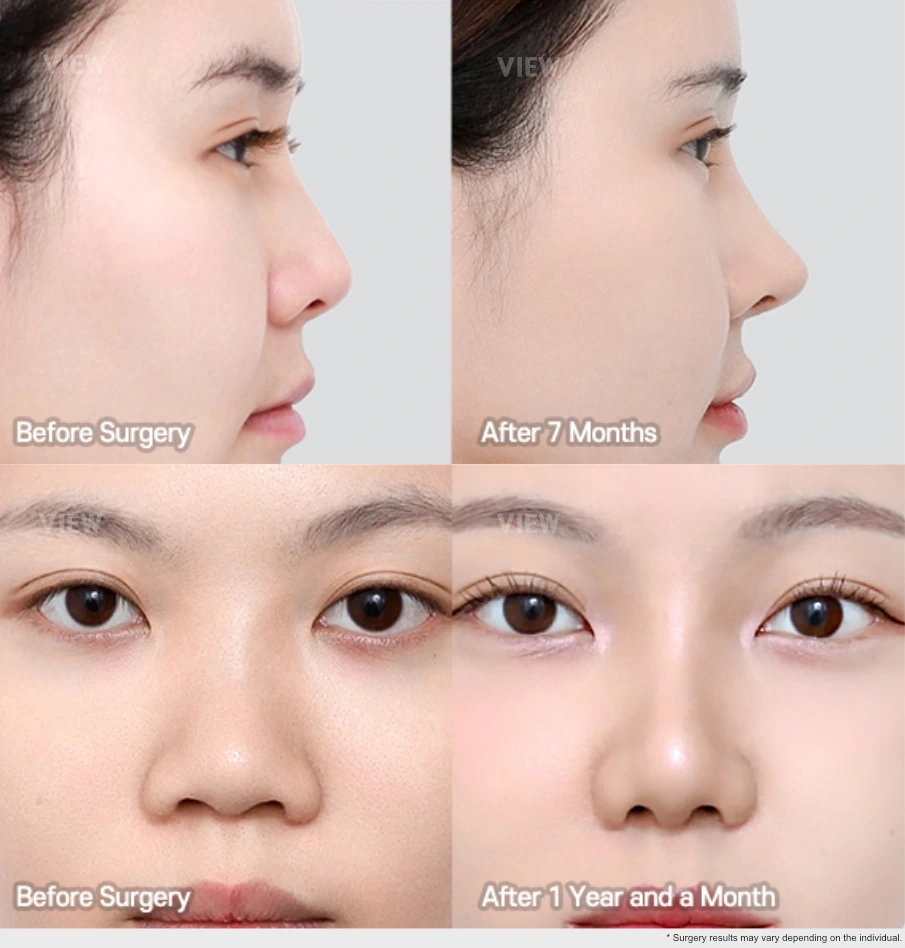 Before and after comparison of rhinoplasty showing stabilized nasal shape at 7 months and 13 months after surgery from side and front views.