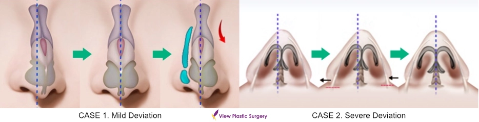 Diagram showing correction of mild and severe septal deviation to improve nasal airway function in functional rhinoplasty