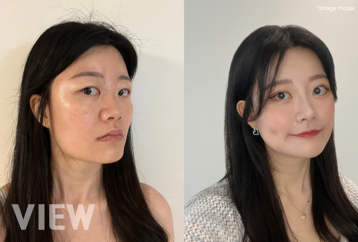Before and after comparison image illustrating changes following square jaw surgery, often performed prior to full facial contouring to improve overall facial balance