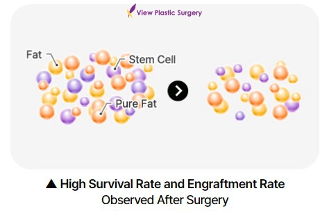 Medical diagram illustrating stem cell–enriched fat grafting, showing the combination of fat and stem cells associated with higher survival and engraftment rates after surgery.