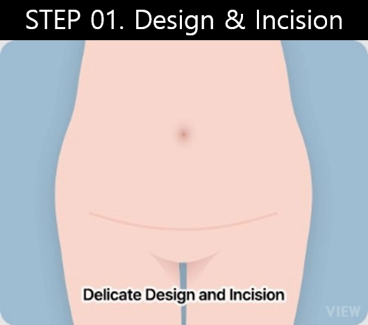 tummy tuck surgery step 1 design and incision illustration