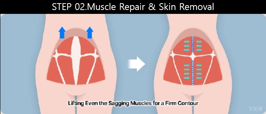 tummy tuck surgery step 2 muscle repair skin removal illustration