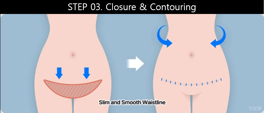 tummy tuck surgery step 3 closure contouring waistline
