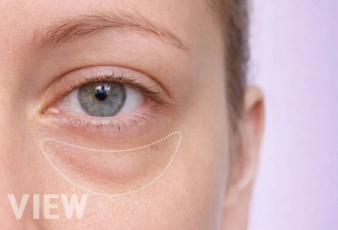 Under-eye bag and tear trough area highlighted for lower eyelid correction