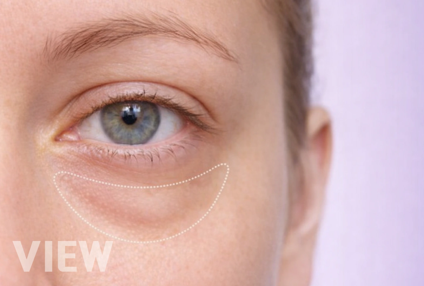 Close-up image highlighting the under eye bag and tear trough area, commonly assessed before under eye surgery to address puffiness and hollowing.