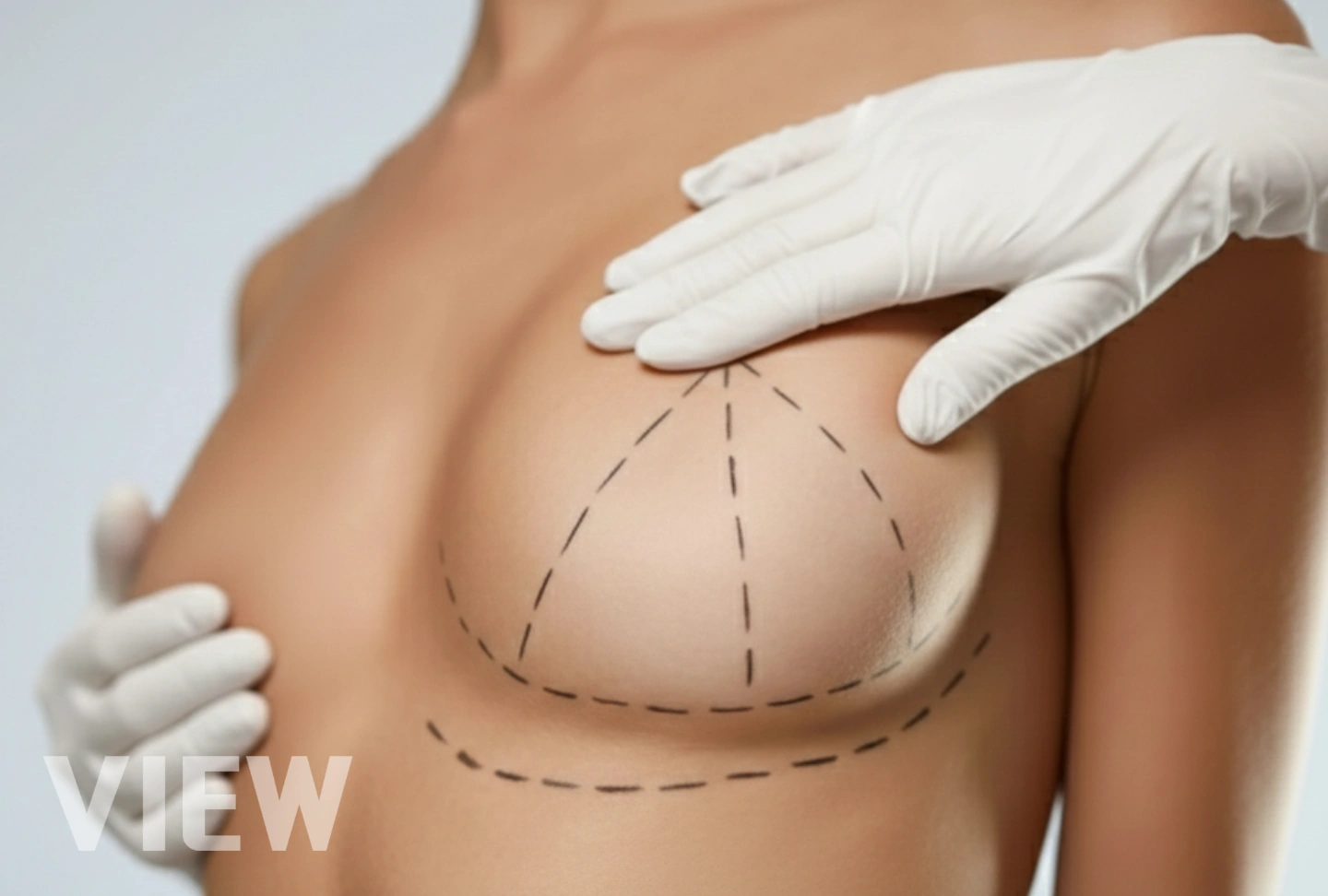 when breast implants are not enough need a breast lift