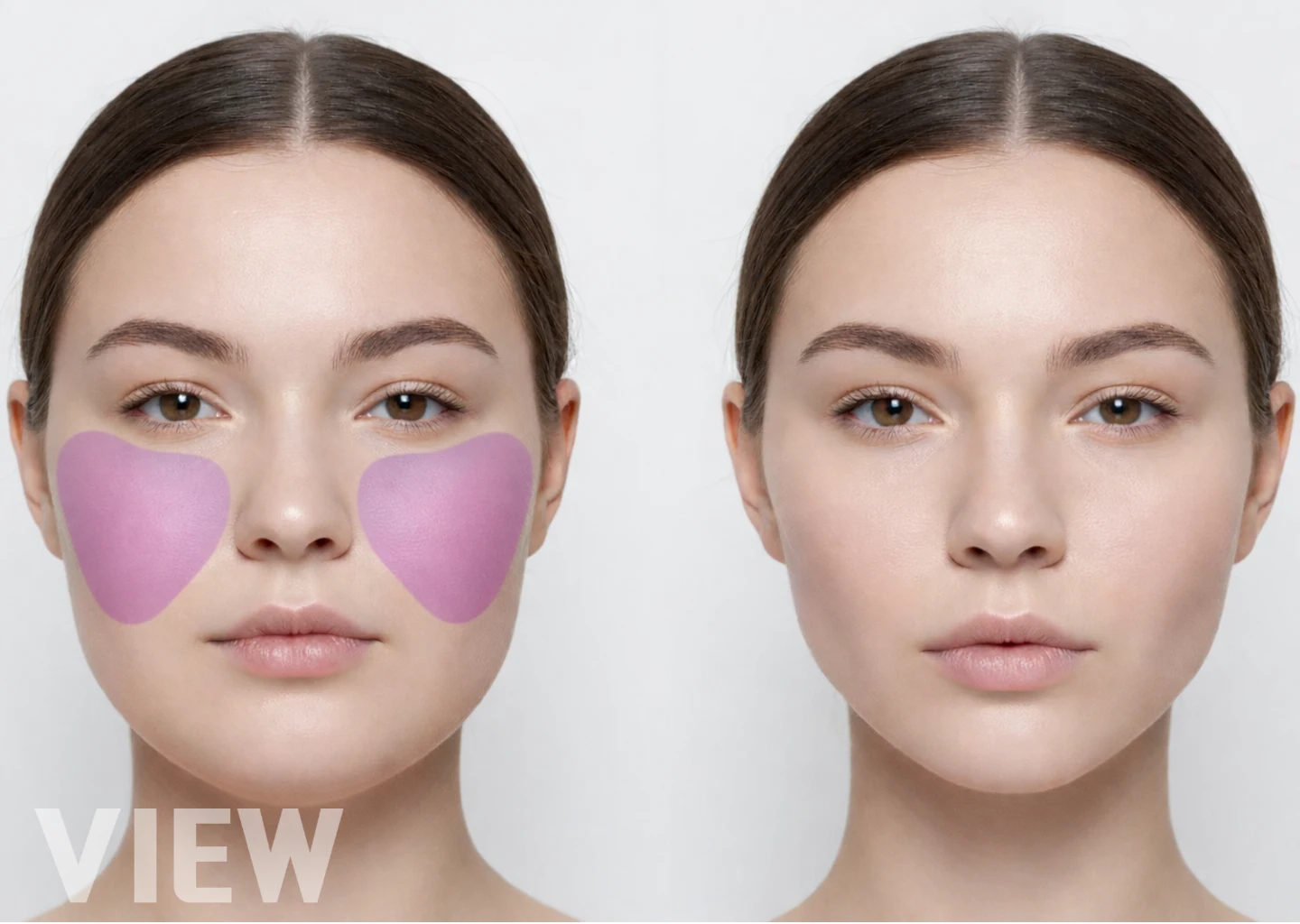 Buccal Fat Removal anatomy illustration showing buccal fat pad extending downward toward both mouth corners and comparison of youthful vs aged midface volume