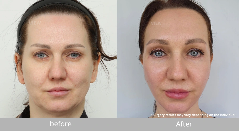Buccal Fat Removal before and after comparison showing reduced cheek volume and enhanced midface contour