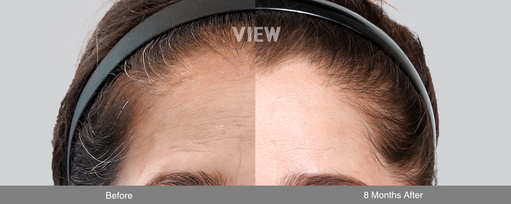 Endotine brow lift effect before and after 8 months showing elevated brow position, smoother forehead contour, and improved upper eye area appearance