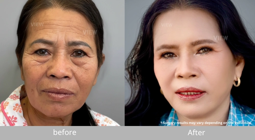 endotine brow lift lower blepharoplasty before after