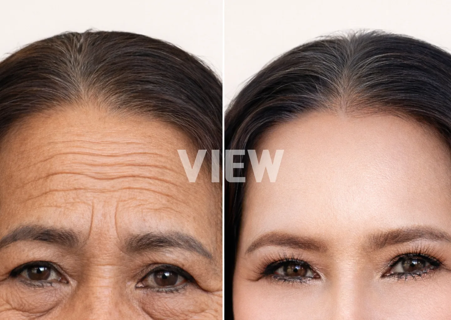 Endotine lift before and after results in Korea showing improved mid-face elevation and smoother cheek contour